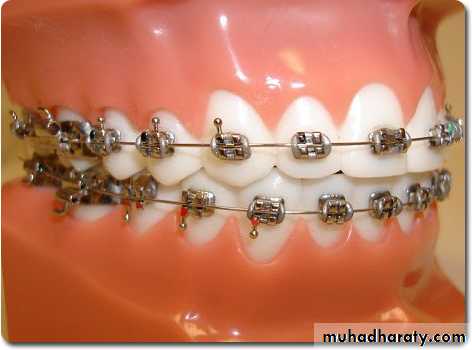 Fixed Orthodontic Appliances Pptx Dr Hakam Muhadharaty