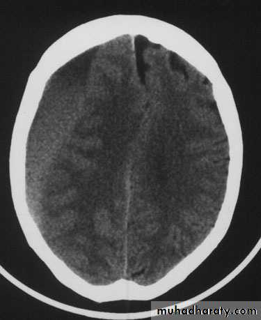 traumatic iliopsoas muscle hematoma icd 10