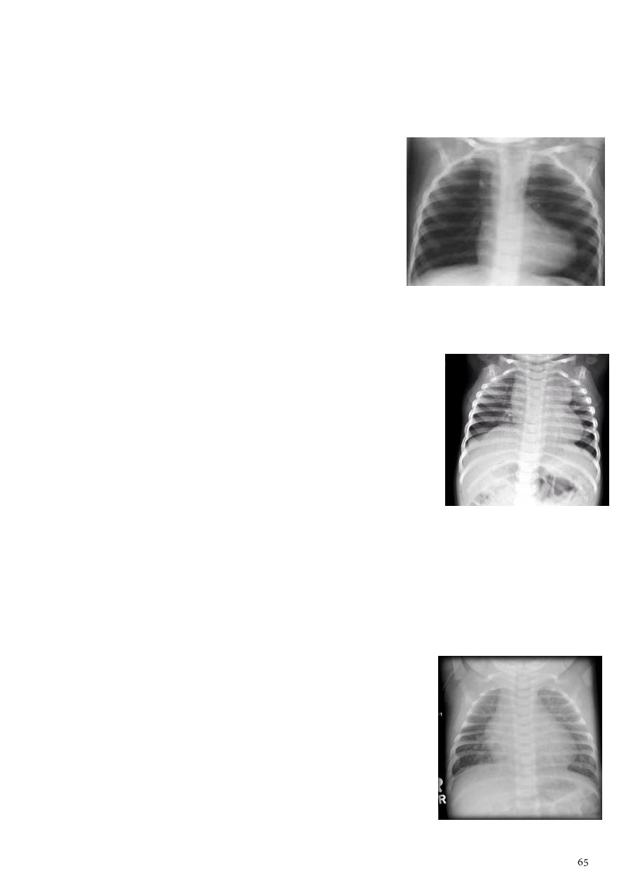 The Signet Ring Sign | Radiology