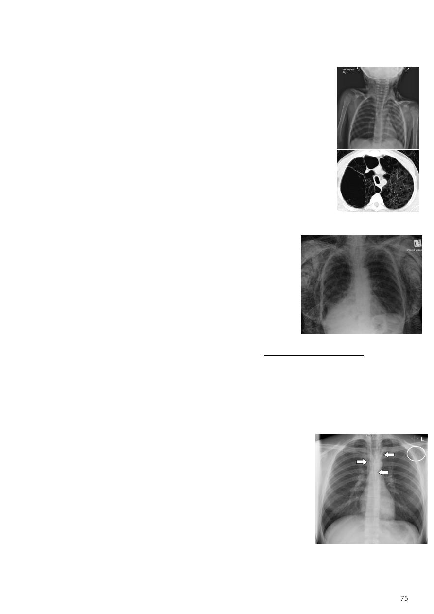 Signet Ring Sign | Radiology Key