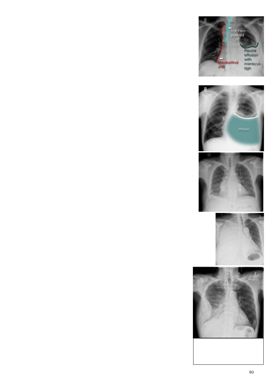 cystic-fibrosis-findings-on-chest-x-ray-and-lung-window-ct-scan | Calgary  Guide
