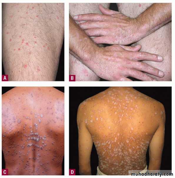 Psoriasis Pptx دصبيح Muhadharaty