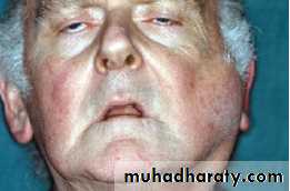little-sex-facial-nerve-palsy-in-parotid-gland-because-of-anaesthesia-teen-porn