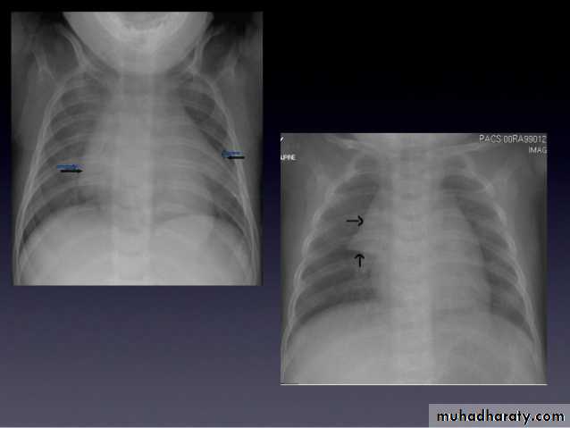 Practical Chest radiology pptx - كتابة الطلاب - Muhadharaty