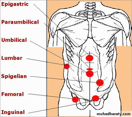 Femoral Hernia Diagram