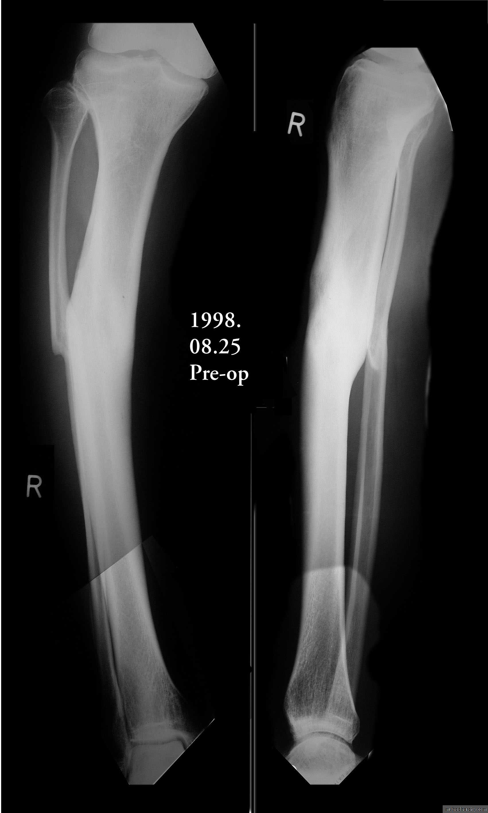 Fractures Shaft Tibia And Fibula Pptx يقظان السليم Muhadharaty