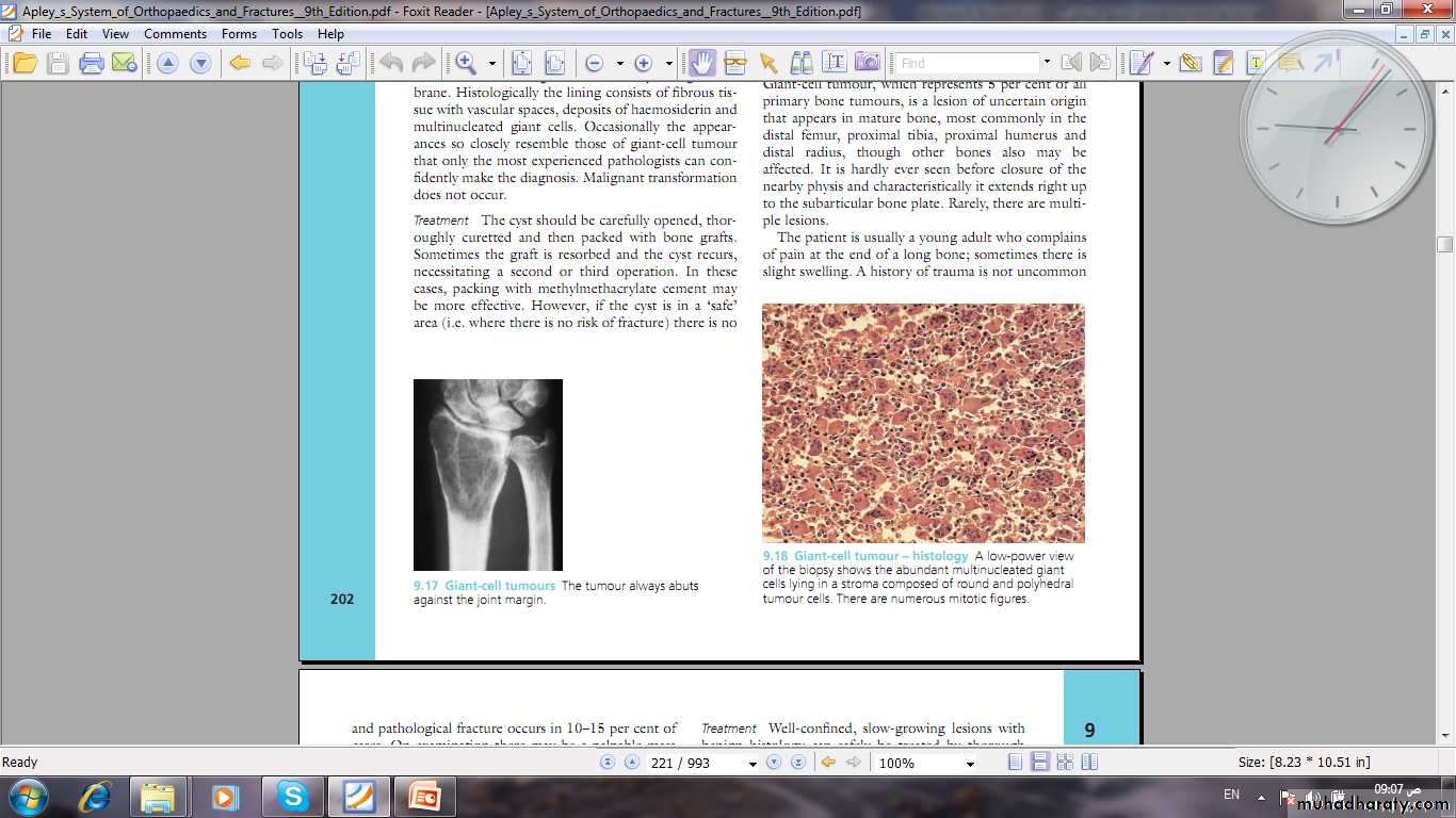 Bone Tumors Pptx محمود الجميلي Muhadharaty