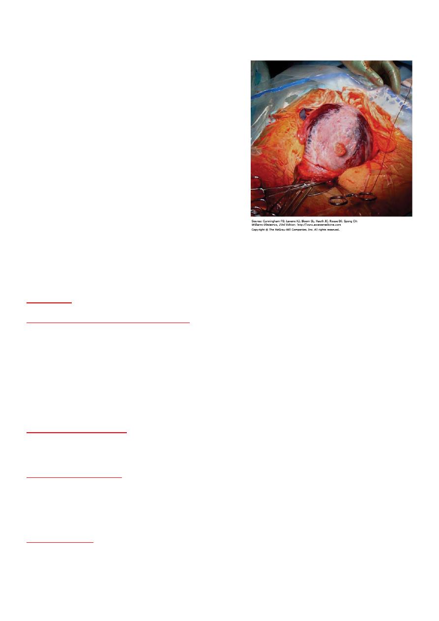 4 Antepartum Haemorrhage Pdf د إيمان Muhadharaty 4 Antepartum Haemorrhage Pdf د إيمان Muhadharaty