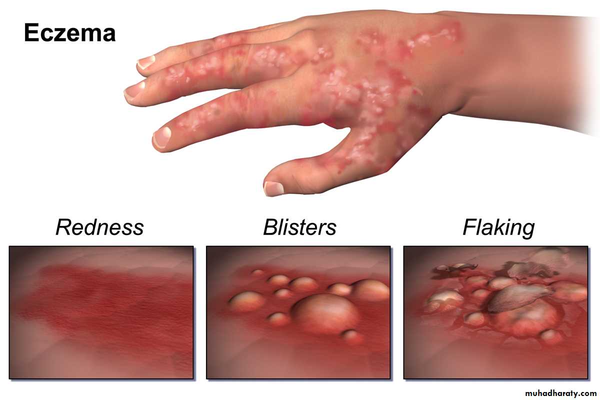 eczema endogeno)