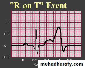 supraventricular tachycardia with ivcd supraventricular tachycardia with ivcd