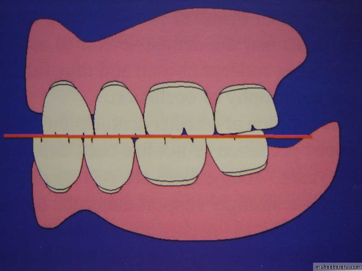 occlusion pptx - Dr.Munia - Muhadharaty