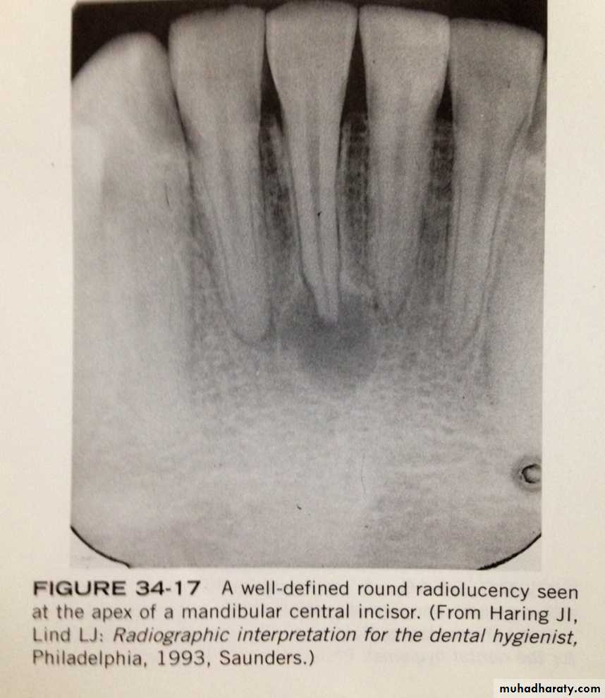 Periapical Abscess Radiograph