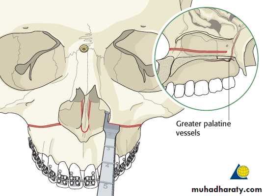 orthognathic surgery pptx  - Muhadharaty