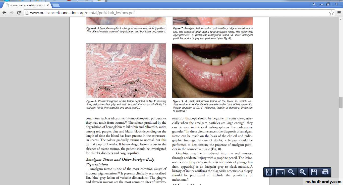 Amalgam tattoo versus melanocytic neoplasm - Differential diagnosis of dark  pigmented oral mucosa lesions using infrared spectroscopy | PLOS ONE