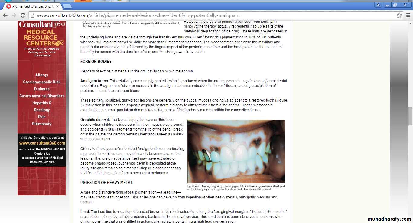 Pigmented Disorders of the Oral Cavity Flashcards | Quizlet