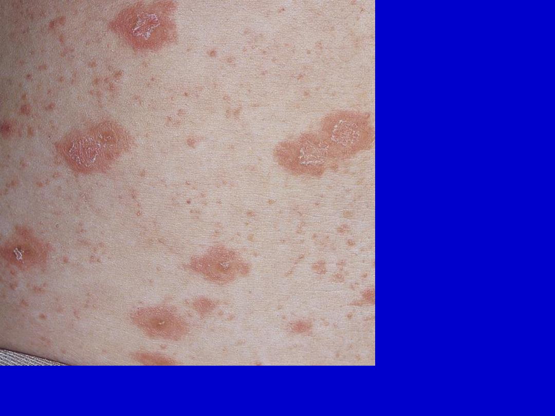 Viral Skin Diseases Ppt Pdf د سلام التميمي Muhadharaty