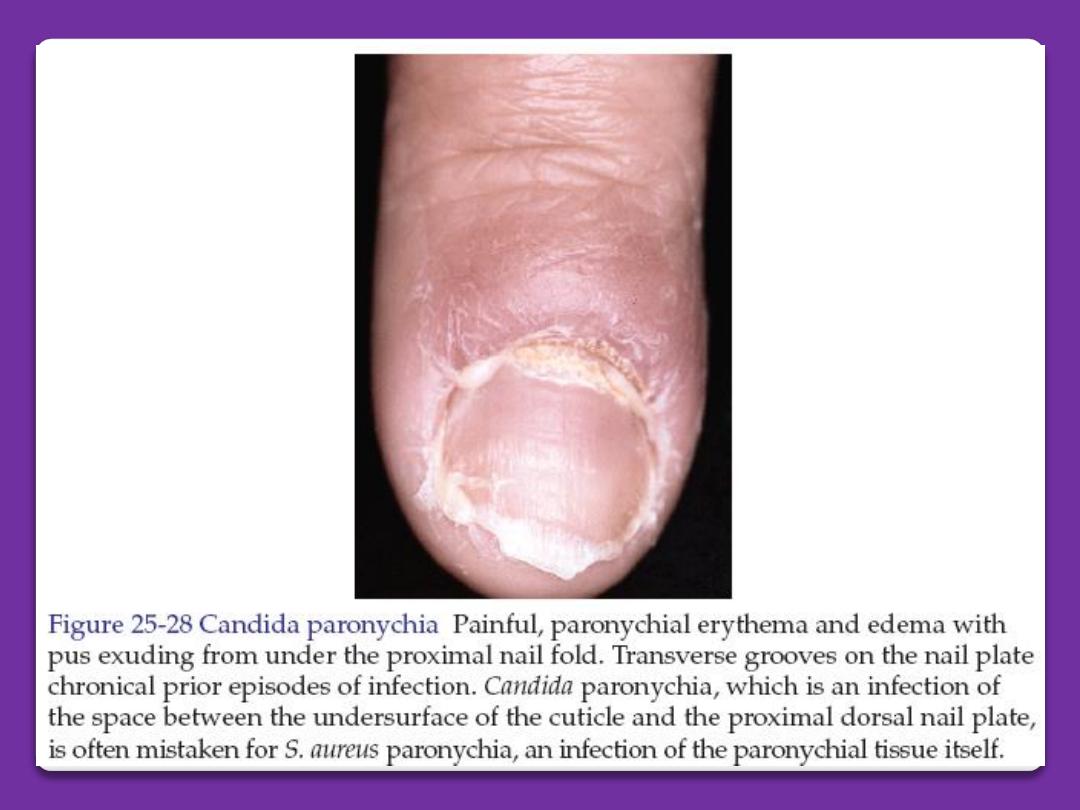 Dr. Salman Hameed - Nail Fold Infection | Facebook