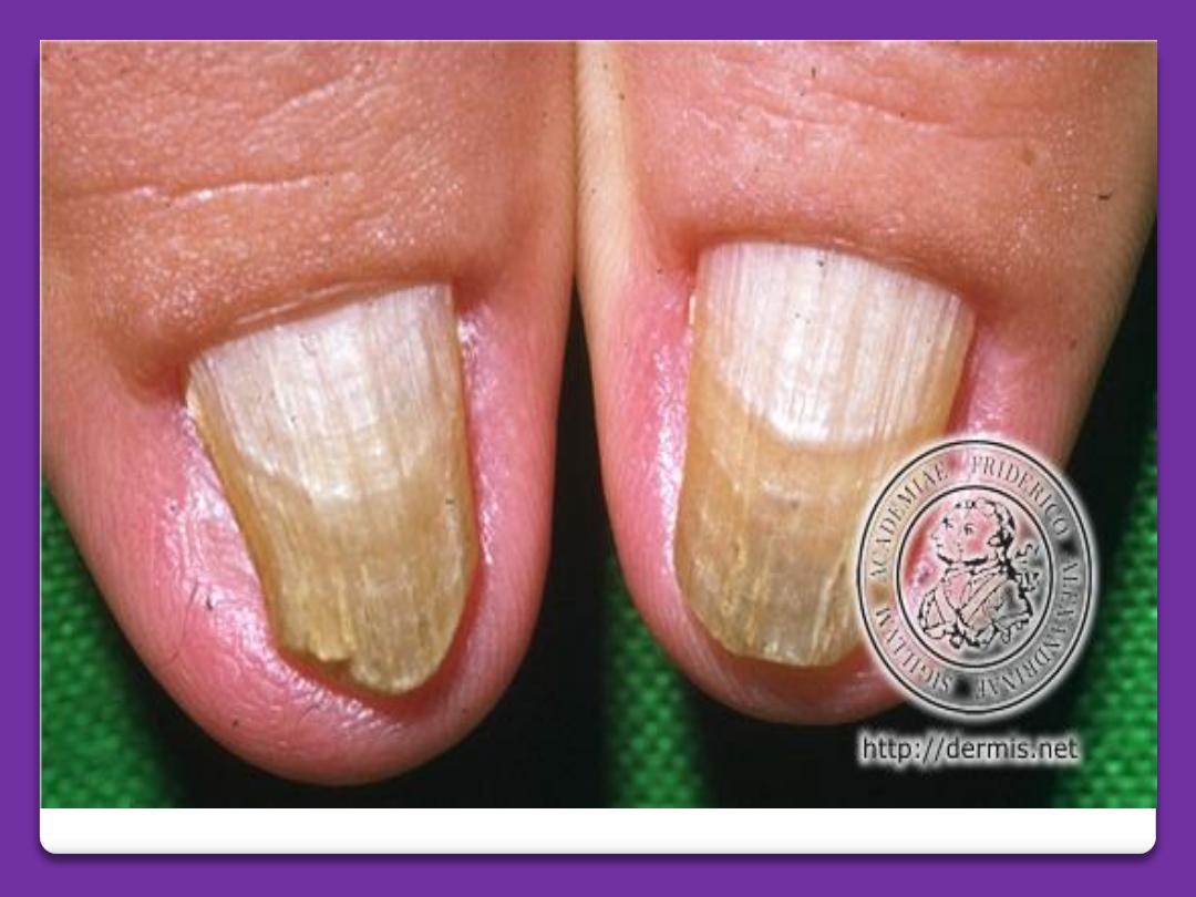 Pitting of fingernails | MDedge Family Medicine
