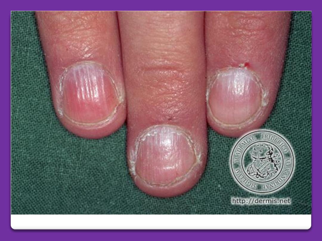 Differential Diagnosis of Nail Psoriasis and Onychomycoses