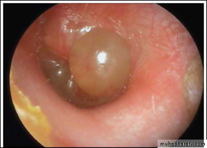 Otitis Externa Docx دعبد الحسين Muhadharaty