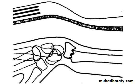 Colles Fracture Pptx د أحمد لطيف