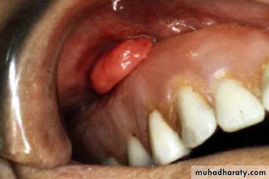 Se puede comer normal con dentadura postiza