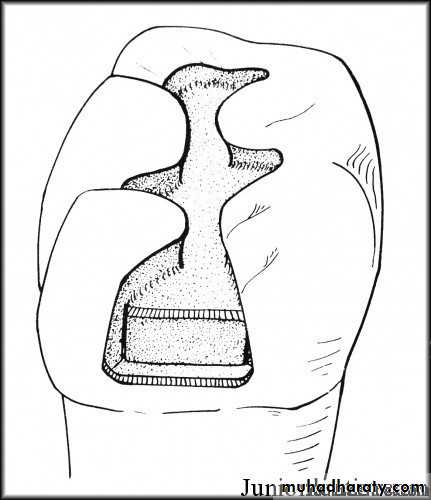 Class II cavity preparation for amalgam - mandibular molar #36 -  Preclinical Operative - Arabic عربي 