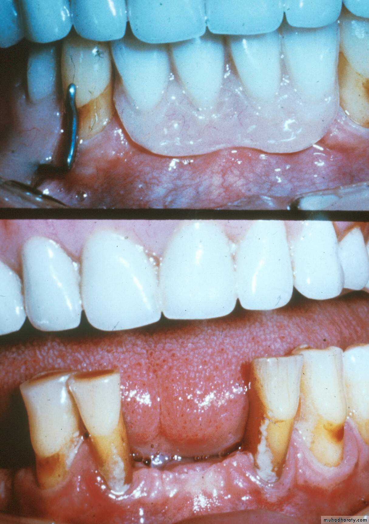 immediate denture pptx د.عمار النوري Muhadharaty