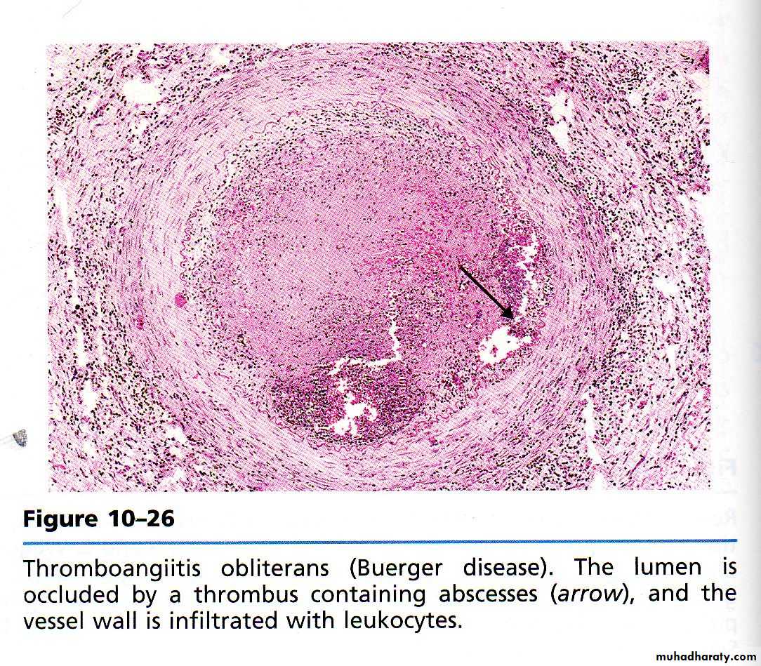 Тромб микропрепарат. Смешанный тромб артерии микропрепарат. Тромбофлебит гистология. Красный обтурирующий тромб микропрепарат.