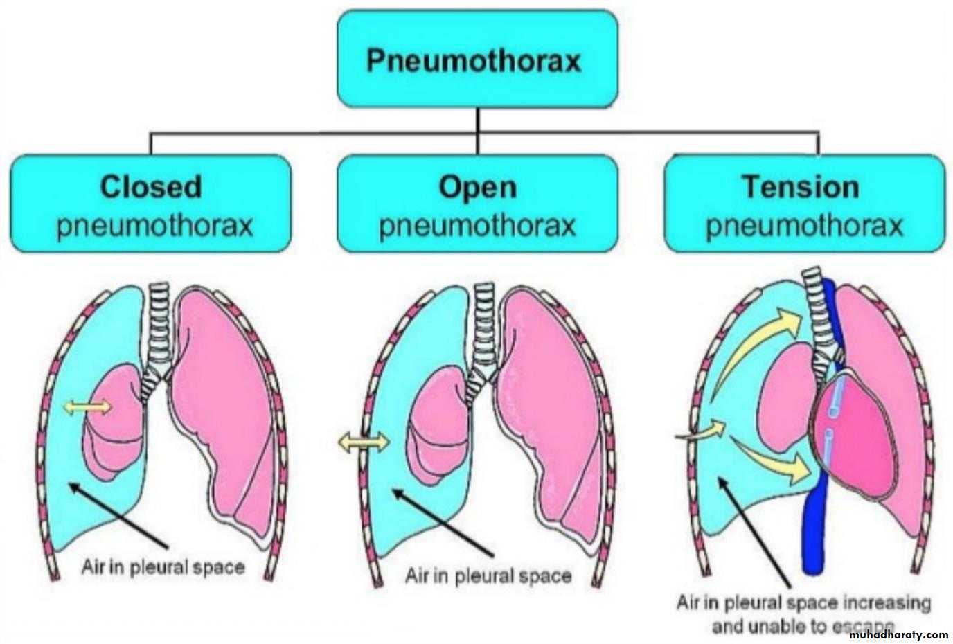 Open pressure. Закрытый пневмоторакс схема. Пневмоторакс схема. Искусственный пневмоторакс.