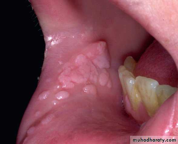 Florid papillomatosis what is it. How to cure papilloma virus Treatment for florid papillomatosis