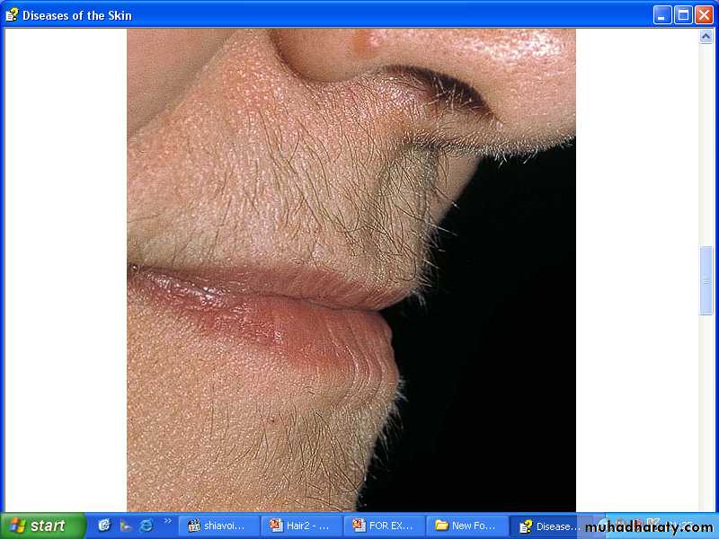 Excessive Hair Growth and Nail Problems pptx - D. Kadhim - Muhadharaty Excessive Hair Growth and Nail Problems pptx - D. Kadhim - Muhadharaty