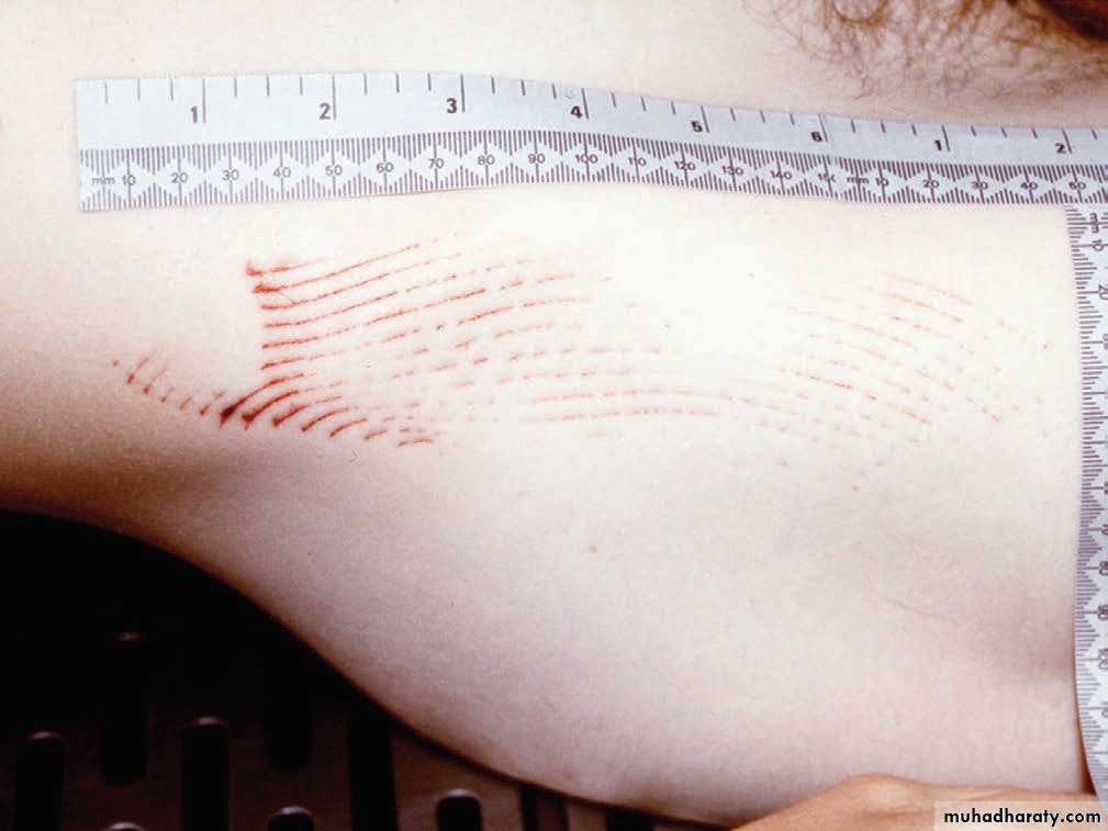 Wounds pptx عملي Muhadharaty
