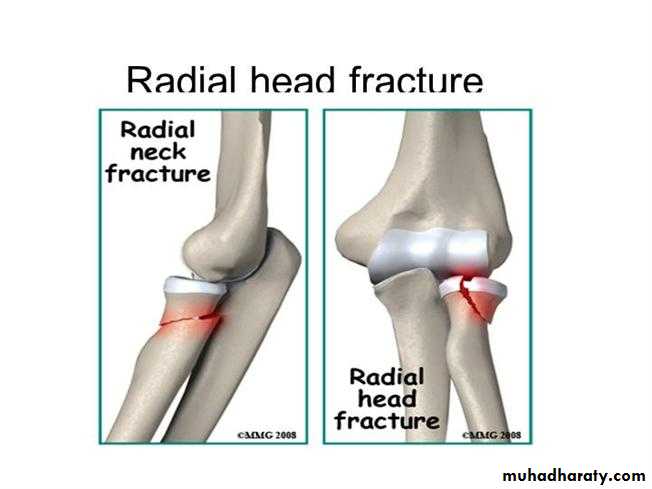 Elbow Injuries in Adult docx - D. Khalid - Muhadharaty