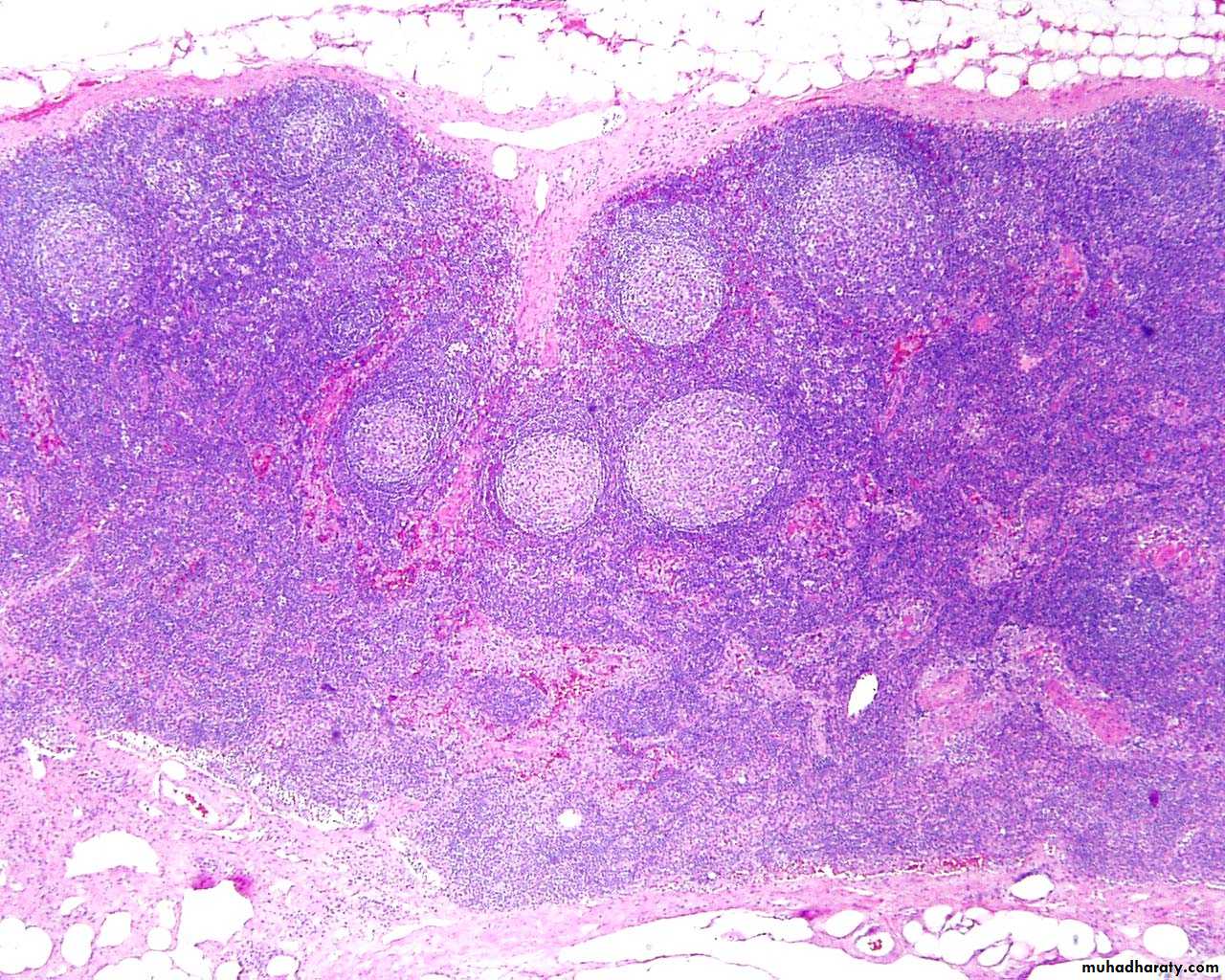 Pathology Of Lymph Node Pptx D Hameed Muhadharaty